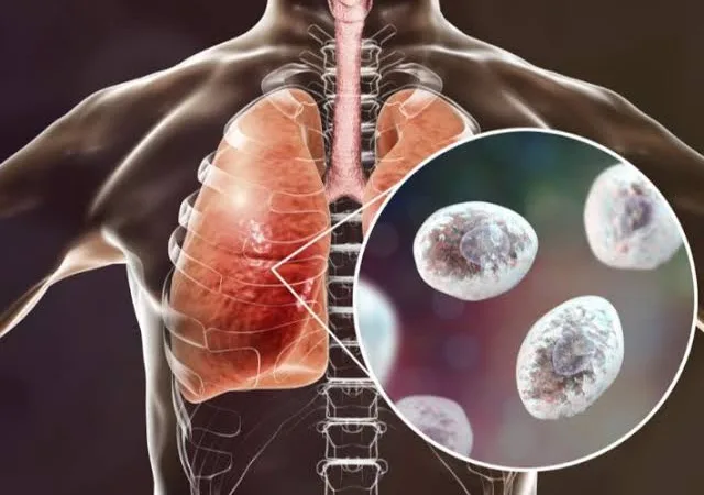 دراسة علمية حديثة: الحساسية قد تقي من خطر الإصابة بسرطان الرئة 6 - CJ العربية IMG 9746 - CJ العربية